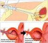 transüretral prostat rezeksiyonu / #876106