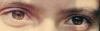 heterochromia iridis